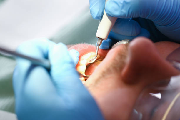 Best Emergency Gum Treatment in Beloit, KS